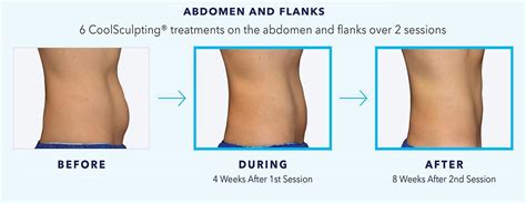 recovery after coolsculpting.